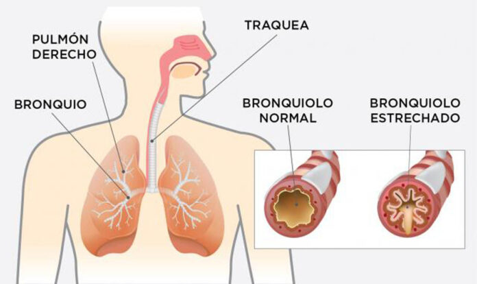 enfermedades respiratorias crónicas
